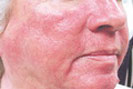 rosacea